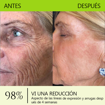 ✨✅𝐑𝐞𝐜𝐮𝐩𝐞𝐫𝐚 𝐥𝐚 𝐩𝐢𝐞𝐥 𝐣𝐨𝐯𝐞𝐧 𝐚𝐡𝐨𝐫𝐚 🍀𝐒𝐓𝐃𝐄𝐈®𝐁𝐎𝐓𝐎𝐗 & 𝐕𝐈𝐓𝐀𝐌𝐈𝐍𝐀 𝐀 𝐋𝐍𝐘𝐄𝐂𝐂𝐈Ó𝐍 𝐃𝐄 𝐑𝐄𝐓𝐈𝐍𝐎𝐋 𝐑𝐞𝐚𝐟𝐢𝐫𝐦𝐚𝐧𝐭𝐞 𝐀𝐧𝐭𝐢𝐚𝐫𝐮𝐠𝐚𝐬 𝐂𝐫𝐞𝐦𝐚