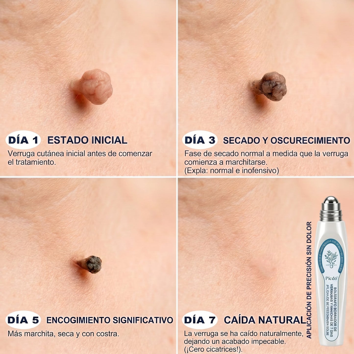 👩🏻‍🔬𝐏𝐢𝐜𝐝𝐨® Borrador de Verrugas y Manchas en 7 Días (𝐀𝐩𝐥𝐢𝐜𝐚𝐝𝐨𝐫 𝐫𝐨𝐥𝐥-𝐨𝐧: 𝐬𝐢𝐧 𝐝𝐨𝐥𝐨𝐫 𝐧𝐢 𝐜𝐢𝐜𝐚𝐭𝐫𝐢𝐜𝐞𝐬)✨