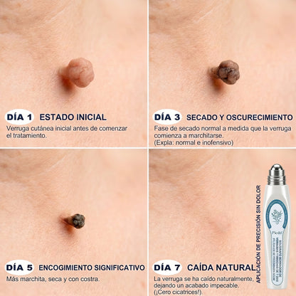 👩🏻‍🔬𝐏𝐢𝐜𝐝𝐨® Borrador de Verrugas y Manchas en 7 Días (𝐀𝐩𝐥𝐢𝐜𝐚𝐝𝐨𝐫 𝐫𝐨𝐥𝐥-𝐨𝐧: 𝐬𝐢𝐧 𝐝𝐨𝐥𝐨𝐫 𝐧𝐢 𝐜𝐢𝐜𝐚𝐭𝐫𝐢𝐜𝐞𝐬)✨