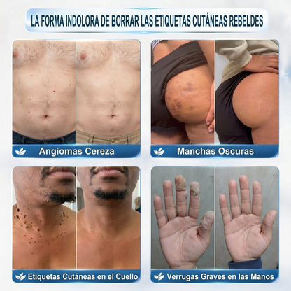 👩🏻‍🔬𝐏𝐢𝐜𝐝𝐨® Borrador de Verrugas y Manchas en 7 Días (𝐀𝐩𝐥𝐢𝐜𝐚𝐝𝐨𝐫 𝐫𝐨𝐥𝐥-𝐨𝐧: 𝐬𝐢𝐧 𝐝𝐨𝐥𝐨𝐫 𝐧𝐢 𝐜𝐢𝐜𝐚𝐭𝐫𝐢𝐜𝐞𝐬)✨