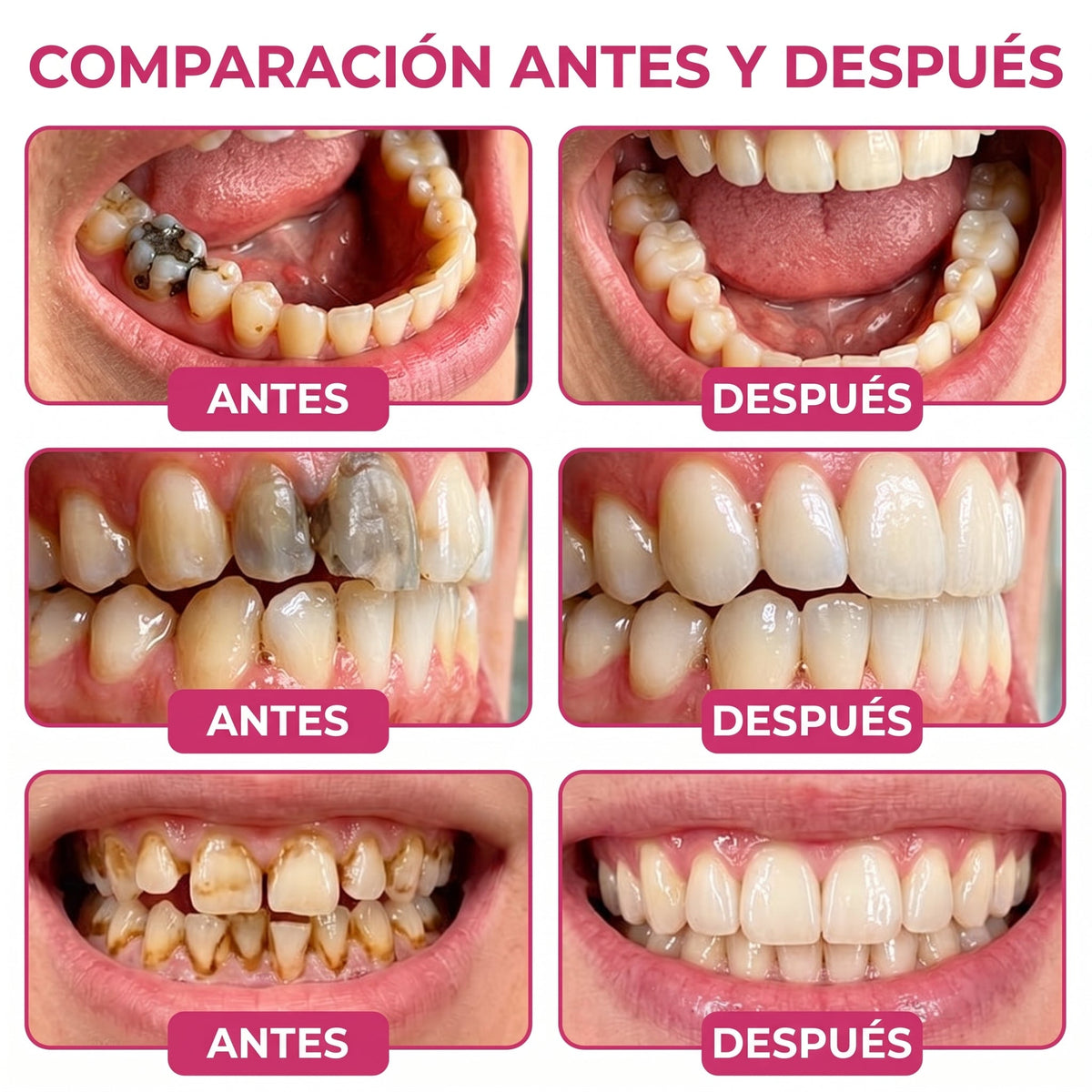 𝐾𝑒𝑦𝑒𝑠𝑠® 🍟🍟𝑅𝑒𝑝𝑎𝑟𝑎𝑐𝑖ó𝑛 𝑑𝑒 𝐶𝑎𝑟𝑖𝑒𝑠 𝐷𝑒𝑛𝑝𝑒𝑟𝑚 𝐺𝑒 𝑁𝑎𝑡𝑢𝑟𝑎𝑙 𝑑𝑒 𝑅𝑒𝑙𝑙𝑒𝑛𝑜 𝑑𝑒𝑙 𝐸𝑠𝑚𝑎𝑙𝑡𝑒, 𝑫𝒊𝒆𝒏𝒕𝒆𝒔 𝒔𝒆𝒏𝒔𝒊𝒃𝒍𝒆𝒔 𝒚 𝒆𝒔𝒎𝒂𝒍𝒕𝒆 𝒅𝒆𝒃𝒊𝒍𝒊𝒕𝒂𝒅𝒐 (𝑪𝒐𝒑𝒊𝒂)