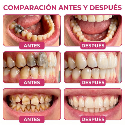 𝐾𝑒𝑦𝑒𝑠𝑠® 🍟🍟𝑅𝑒𝑝𝑎𝑟𝑎𝑐𝑖ó𝑛 𝑑𝑒 𝐶𝑎𝑟𝑖𝑒𝑠 𝐷𝑒𝑛𝑝𝑒𝑟𝑚 𝐺𝑒 𝑁𝑎𝑡𝑢𝑟𝑎𝑙 𝑑𝑒 𝑅𝑒𝑙𝑙𝑒𝑛𝑜 𝑑𝑒𝑙 𝐸𝑠𝑚𝑎𝑙𝑡𝑒, 𝑫𝒊𝒆𝒏𝒕𝒆𝒔 𝒔𝒆𝒏𝒔𝒊𝒃𝒍𝒆𝒔 𝒚 𝒆𝒔𝒎𝒂𝒍𝒕𝒆 𝒅𝒆𝒃𝒊𝒍𝒊𝒕𝒂𝒅𝒐 (𝑪𝒐𝒑𝒊𝒂)