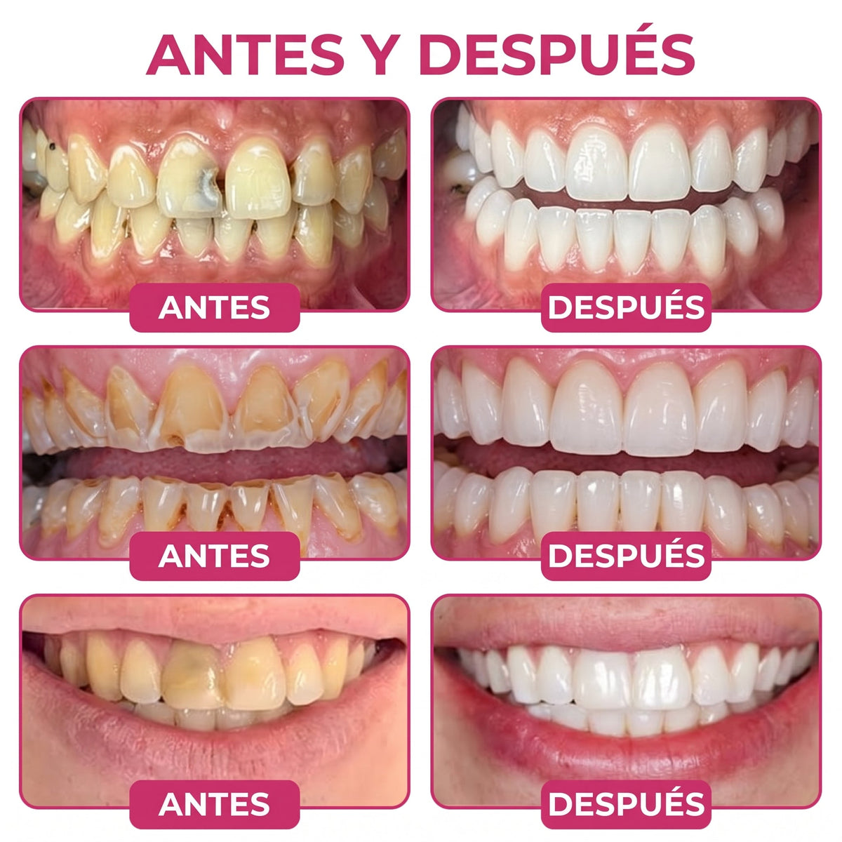 𝐾𝑒𝑦𝑒𝑠𝑠® 🍟🍟𝑅𝑒𝑝𝑎𝑟𝑎𝑐𝑖ó𝑛 𝑑𝑒 𝐶𝑎𝑟𝑖𝑒𝑠 𝐷𝑒𝑛𝑝𝑒𝑟𝑚 𝐺𝑒 𝑁𝑎𝑡𝑢𝑟𝑎𝑙 𝑑𝑒 𝑅𝑒𝑙𝑙𝑒𝑛𝑜 𝑑𝑒𝑙 𝐸𝑠𝑚𝑎𝑙𝑡𝑒, 𝑫𝒊𝒆𝒏𝒕𝒆𝒔 𝒔𝒆𝒏𝒔𝒊𝒃𝒍𝒆𝒔 𝒚 𝒆𝒔𝒎𝒂𝒍𝒕𝒆 𝒅𝒆𝒃𝒊𝒍𝒊𝒕𝒂𝒅𝒐 (𝑪𝒐𝒑𝒊𝒂)
