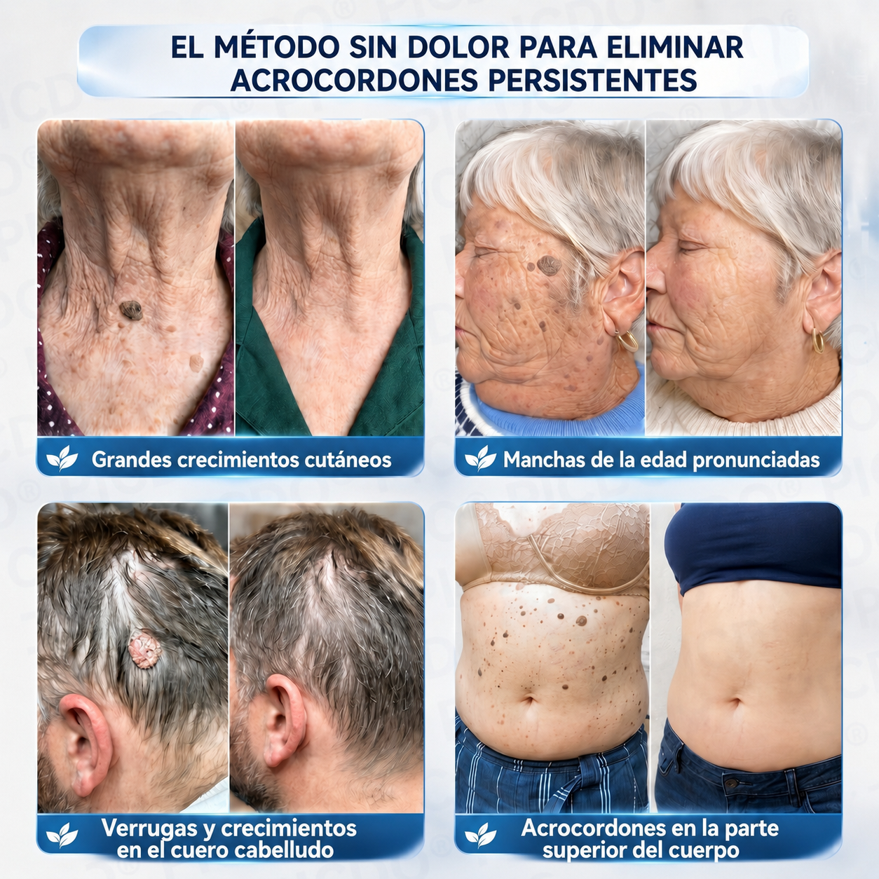 🔥💥𝐏𝐢𝐜𝐝𝐨® 𝑪𝒓𝒆𝒎𝒂 𝑩𝒐𝒓𝒓𝒂𝒅𝒐𝒓𝒂 𝒅𝒆 𝑨𝒄𝒓𝒐𝒄𝒐𝒓𝒅𝒐𝒏𝒆𝒔 𝒚 𝑴𝒂𝒏𝒄𝒉𝒂𝒔 𝒆𝒏 7 𝑫í𝒂𝒔🩵 (𝐹ó𝑟𝑚𝑢𝑙𝑎 𝑠𝑖𝑛 𝑑𝑜𝑙𝑜𝑟 𝑛𝑖 𝑐𝑖𝑐𝑎𝑡𝑟𝑖𝑐𝑒𝑠) 💪